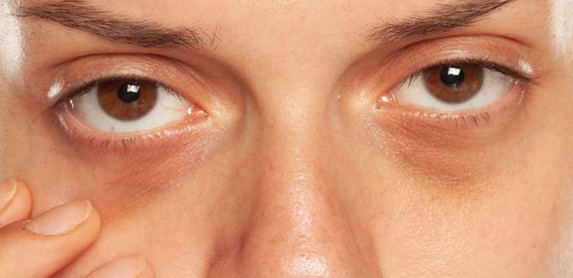 Cu ce probleme de sănătate te confrunți dacă ai cearcăne sub ochi. Ce vitamine sunt necesare pentru a reduce aspectul lor, în mod natural