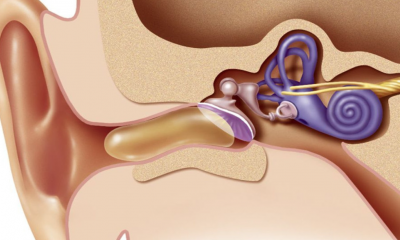 Cu ce se scoate dopul de ceara din ureche: Recomandarea medicilor ORL-isti