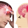 6 semne ale accidentului vascular cerebral pe care oamenii le ignora