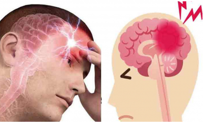 6 semne ale accidentului vascular cerebral pe care oamenii le ignora